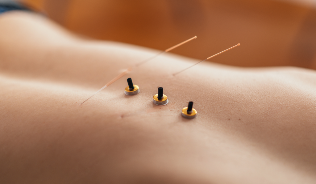 Therapeutic Benefits of Moxibustion in Acupuncture