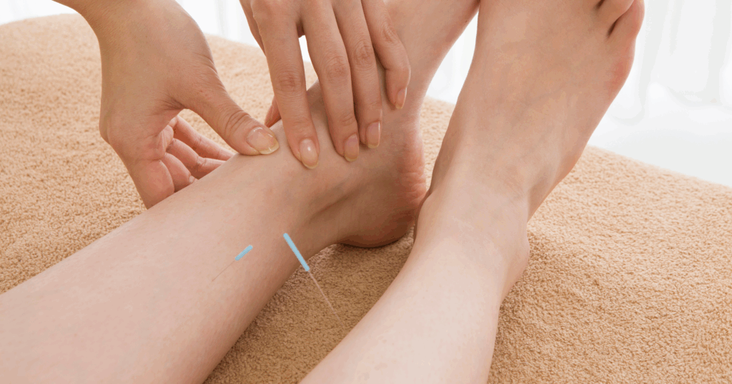 how-acupuncture-helps-shin-splints