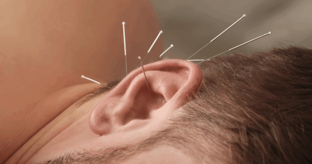 how-acupuncture-may-help-tinnitus