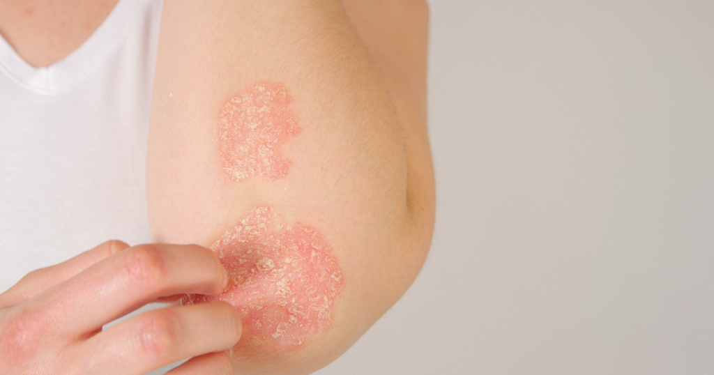 understanding-eczema-from-a-tcm-perspective