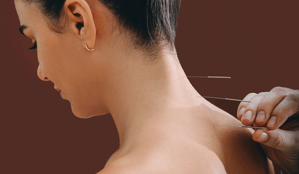 How Acupuncture Addresses Splenius Capitis Pain
