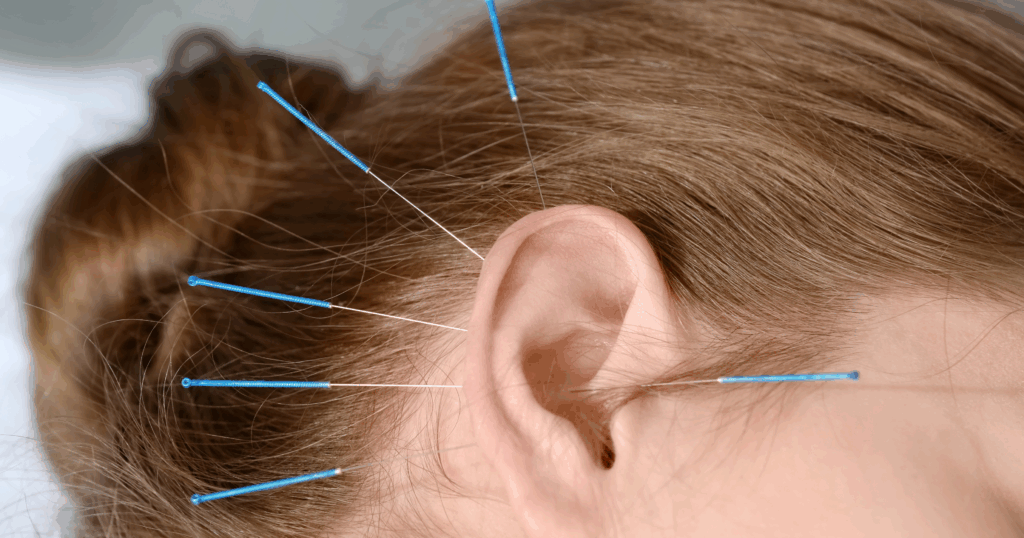 advanced-acupuncture-techniques-for-vertigo-relief