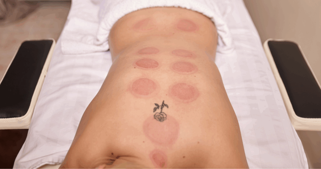 integrating-cupping-into-your-lower-back-pain-management-plan