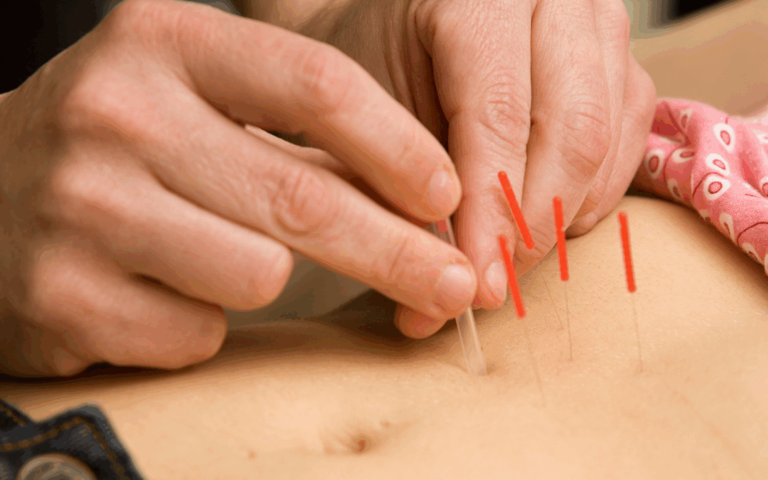 Acupuncture and Moxibustion for Irritable Bowel Syndrome (IBS): A Holistic Approach to Gut Health
